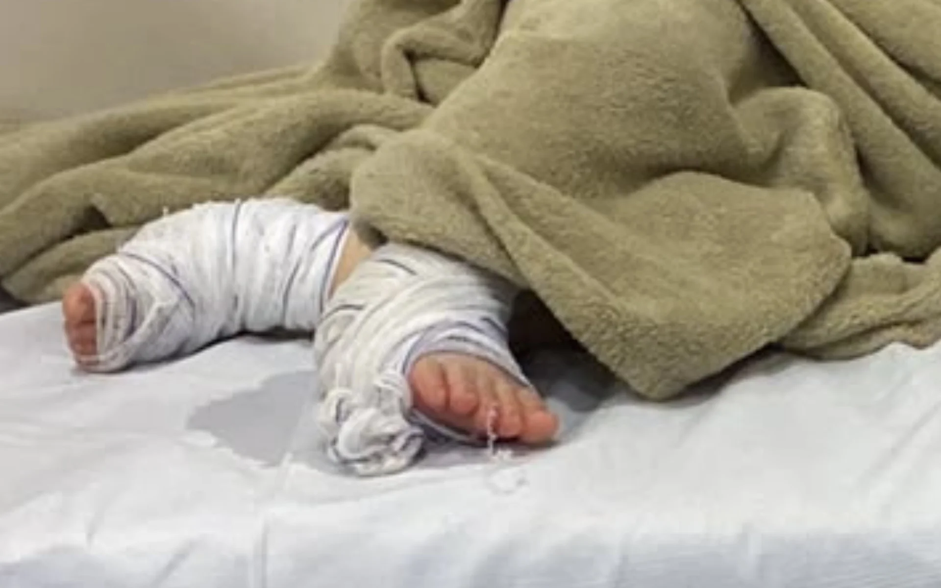 Servidora é demitida e Campo Bom abre sindicância para apurar caso de bebê que teve queimaduras em creche abc+