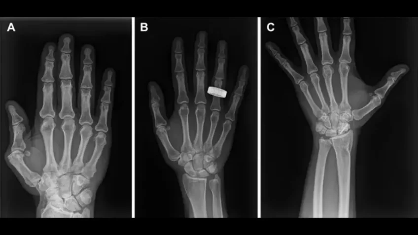 Astronautas tiram radiografias no espaço pela 1ª vez
