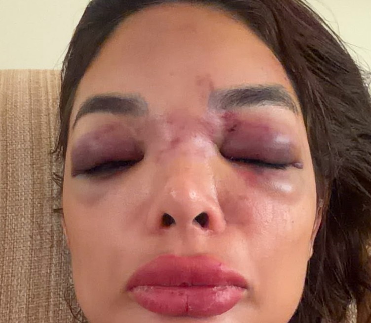 Empresário da Faria Lima é preso em flagrante por agredir mulher: ‘Deixou meu rosto deformado