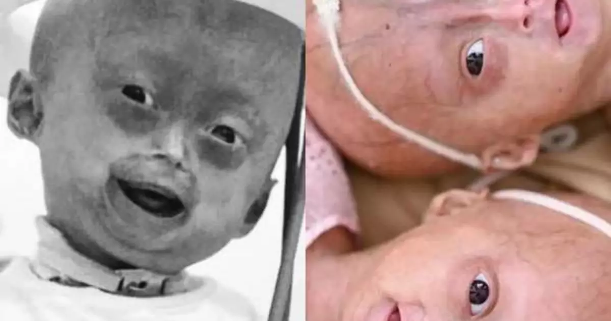 LUTO Influenciadora Elis Lima, gêmea de Eloá, morre aos 5 anos saiba causa do óbito