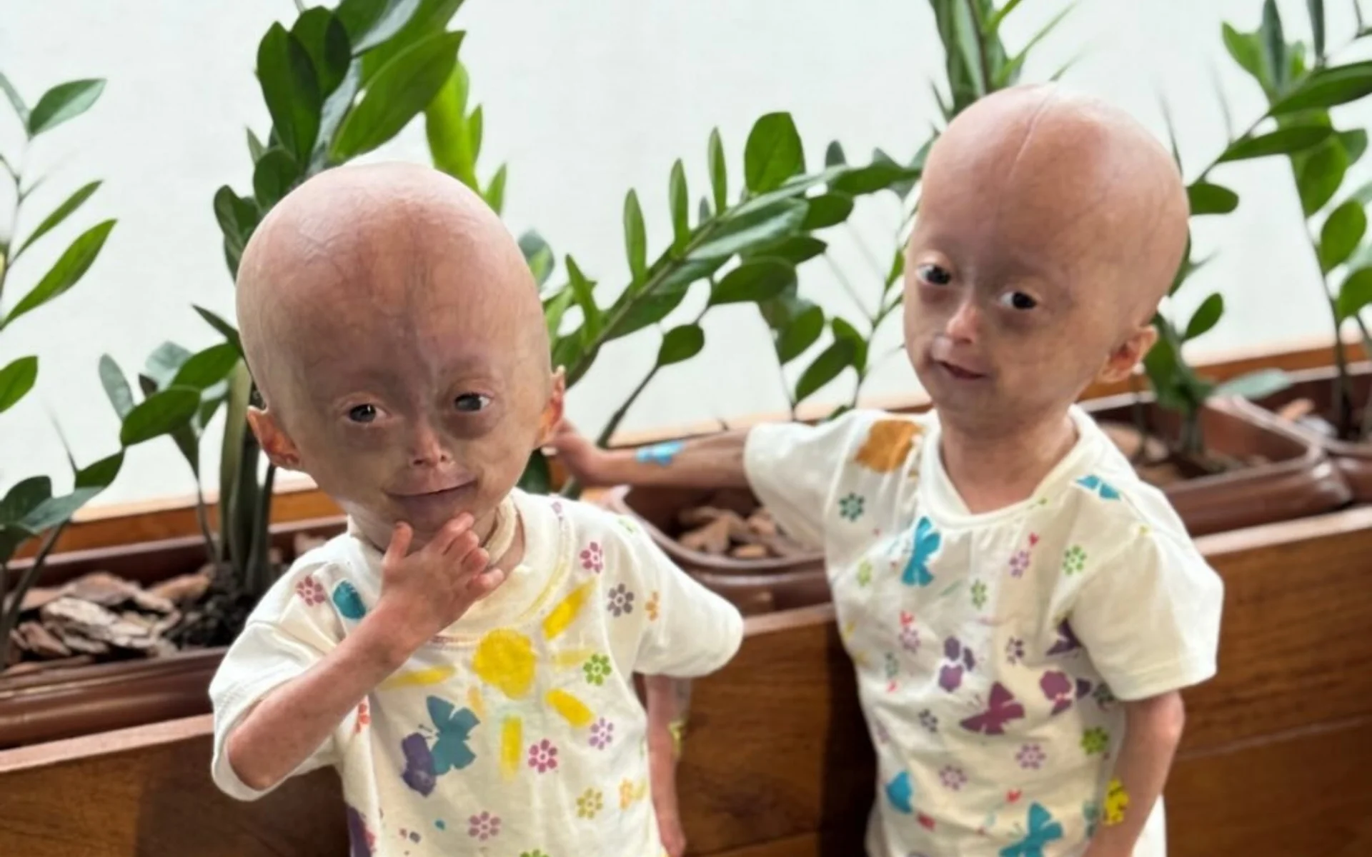 É muito difícil : Morre Elis, de 5 anos, gêmea com síndrome rara que causa envelhecimento precoce abc+