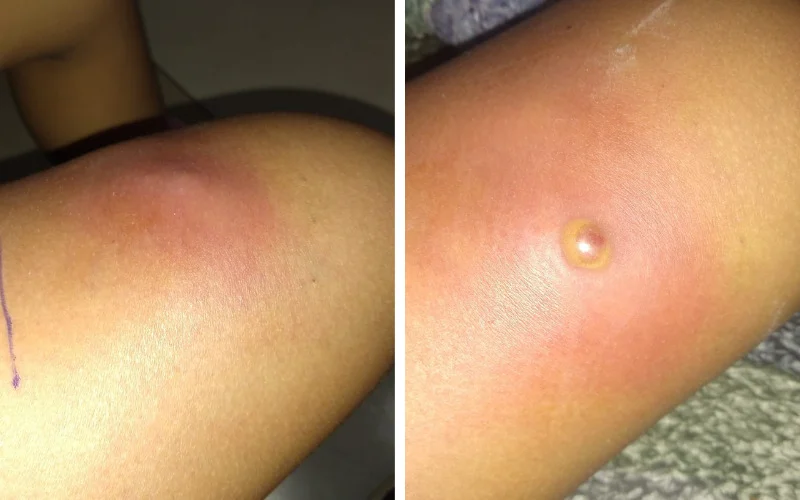 Bichinho com a cauda para cima : Menina de 7 anos é picada por escorpião-preto em Novo Hamburgo abc+
