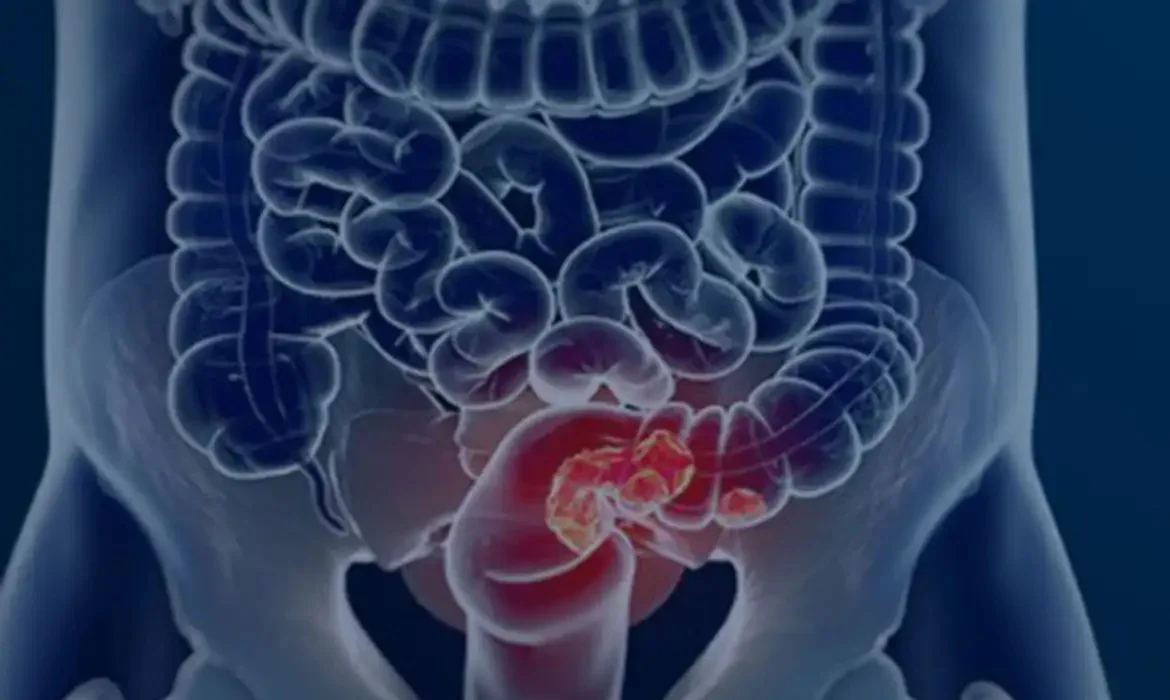 Novo exame para rastrear câncer de intestino é adotado pelo SUS abc+